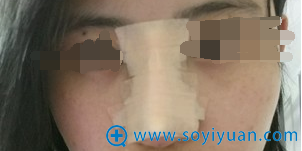硅胶隆鼻术后即刻正面照 硅胶隆鼻术后即刻正面照