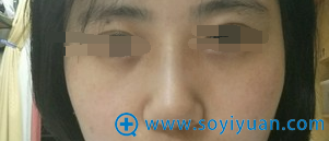 术后第9天,鼻拆线了也消肿了 术后第9天,鼻拆线了也消肿了