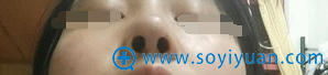 术后第9天,鼻孔内的切口恢复很好 术后第9天,鼻孔内的切口恢复很好