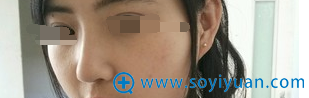 术后15天,鼻子侧面效果 术后15天,鼻子侧面效果