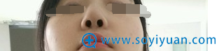 硅胶隆鼻术后15天,切口基本看不见了 硅胶隆鼻术后15天,切口基本看不见了