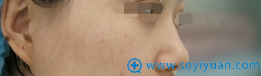 杭州东方整形医院曾茜硅胶假体+耳软骨隆鼻术后15天恢复日记