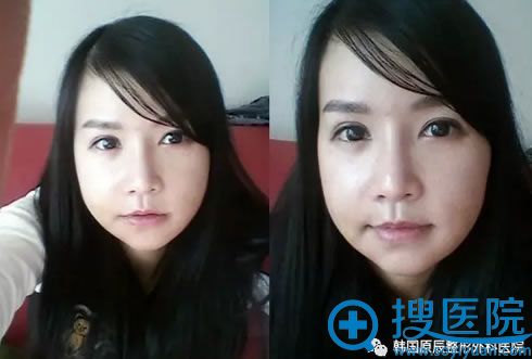 做面部轮廓术后第2周照片 做面部轮廓术后第2周照片