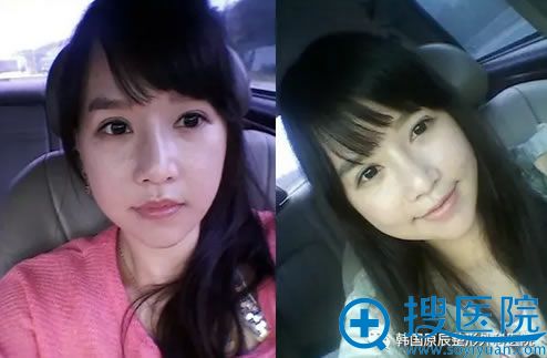 在韩国原辰做V-line手术第3周照片 已经消肿了 在韩国原辰做V-line手术第3周照片 已经消肿了