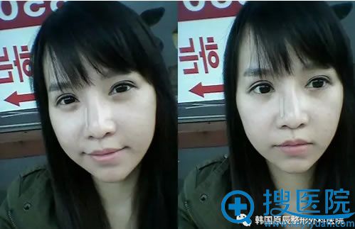 做面部轮廓整形手术第4周美照 做面部轮廓整形手术第4周美照