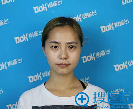 成都铜雀台面部自体脂肪填充真人案例 3900元干瘪脸变少女童颜