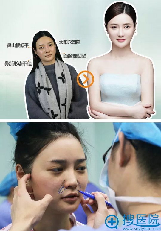 郭世伟主任自体脂肪填充术前设计 郭世伟主任自体脂肪填充术前设计