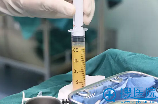 自体脂肪抽取提纯后移植 自体脂肪抽取提纯后移植