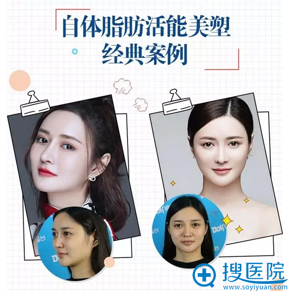 成都铜雀台整形医院自体脂肪真人案例 成都铜雀台整形医院自体脂肪真人案例