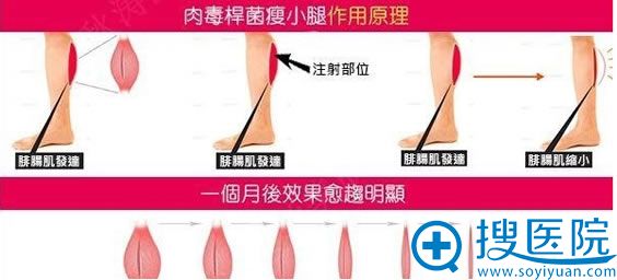 王志军教授解析瘦脸除皱瘦小腿的原理 王志军教授解析瘦脸除皱瘦小腿的原理
