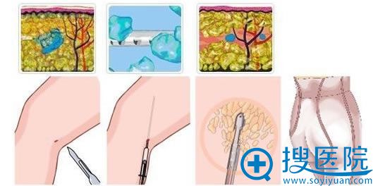 吸脂瘦小腿的原理图 吸脂瘦小腿的原理图