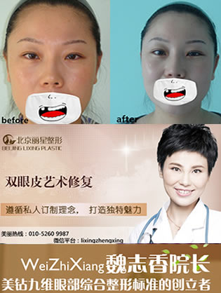 北京丽星双眼皮+假体隆鼻修复案例见证丽星魏志香怎么样?