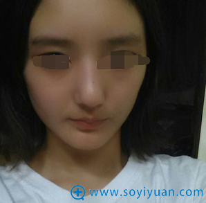 术后19天,消肿后已经可以看出效果了 术后19天,消肿后已经可以看出效果了