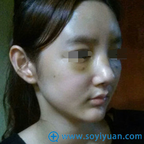 术后4天,可以明显感觉到鼻子和脸颊的变化 术后4天,可以明显感觉到鼻子和脸颊的变化