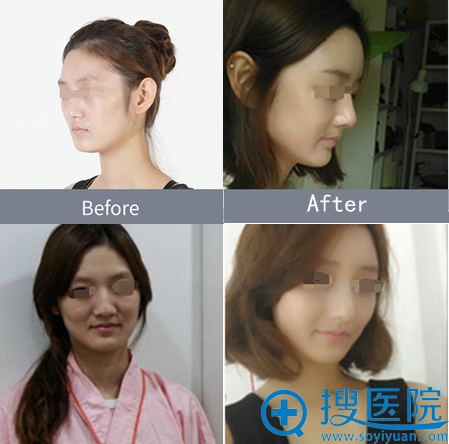 自体脂肪填充脸颊术后一个月对比效果 自体脂肪填充脸颊术后一个月对比效果