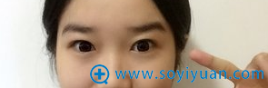北京亚馨美莱坞张海明切开双眼皮术后半年恢复日记