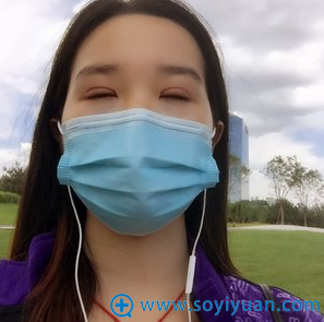 切开双眼皮拆线后闭眼效果 切开双眼皮拆线后闭眼效果