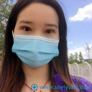切开双眼皮拆线后睁眼效果 切开双眼皮拆线后睁眼效果