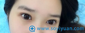 切开双眼皮术后44天效果 切开双眼皮术后44天效果