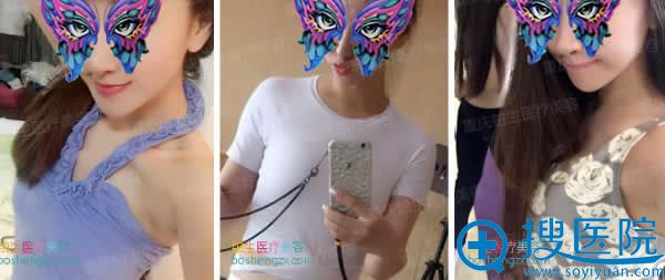 自体脂肪注射隆胸前照片_<!--<i data=20240710 data-id=12390></i>-->整形 自体脂肪注射隆胸前照片_<!--<i data=20240710 data-id=12390></i>-->整形