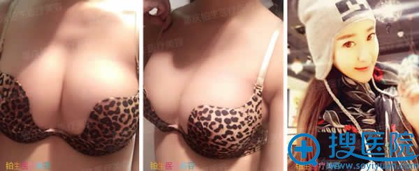在<!--<i data=20240710 data-id=12390></i>-->做完自体脂肪注射隆胸术七天 在<!--<i data=20240710 data-id=12390></i>-->做完自体脂肪注射隆胸术七天