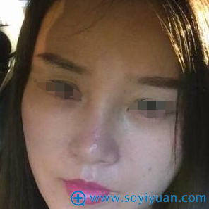 术后第四天,效果更好了,重现年轻V脸 术后第四天,效果更好了,重现年轻V脸