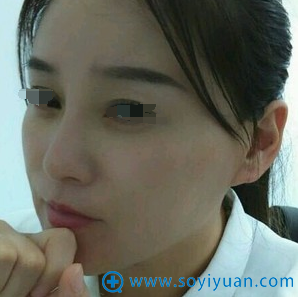 术后第六条,感觉埋线确实比化妆品保养效果好 术后第六条,感觉埋线确实比化妆品保养效果好
