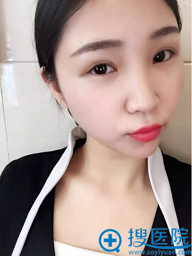 美莱切开双眼皮术后效果 美莱切开双眼皮术后效果
