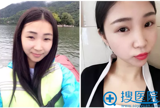 美莱切开双眼皮术前术后对比照 美莱切开双眼皮术前术后对比照