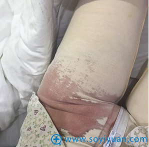 北京伟力嘉美信马永奇激光溶脂瘦大腿术后一个月恢复日记