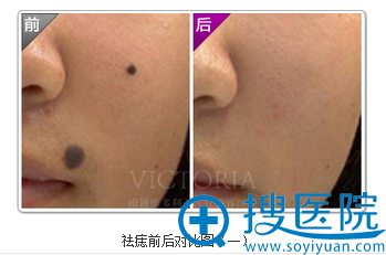 南通维多利亚点痣案例 南通维多利亚点痣案例