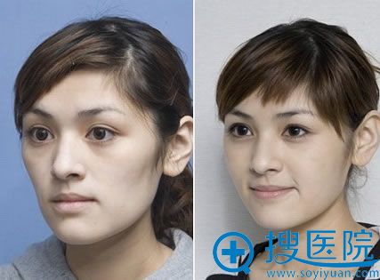 王毅超教授注射爱贝芙案例对比图 王毅超教授注射爱贝芙案例对比图