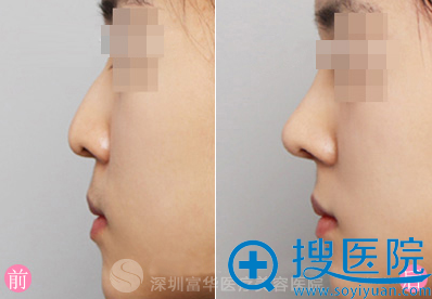 深圳富华整形美容医院假体隆鼻案例 深圳富华整形美容医院假体隆鼻案例