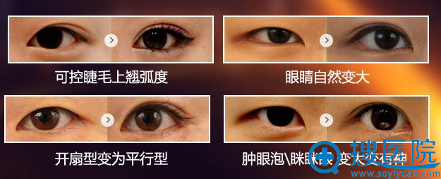 太原华美徐健帆双眼皮案例 太原华美徐健帆双眼皮案例