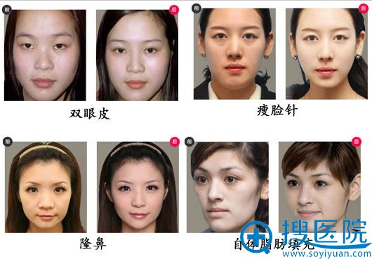 福州名韩整形美容医院案例对比图集 福州名韩整形美容医院案例对比图集