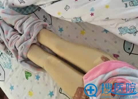 在青岛壹美做吸脂瘦腿手术第1天 在青岛壹美做吸脂瘦腿手术第1天