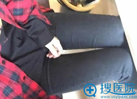 青岛壹美大腿吸脂手术半个月效果 青岛壹美大腿吸脂手术半个月效果