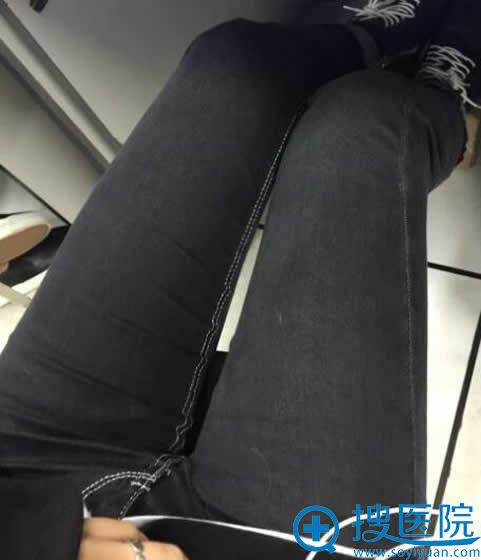 做完吸脂瘦腿后1个月_青岛壹美整形 做完吸脂瘦腿后1个月_青岛壹美整形