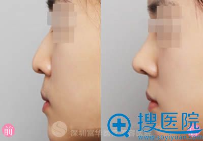 深圳富华假体隆鼻案例对比 深圳富华假体隆鼻案例对比