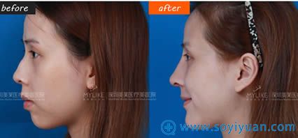深圳美莱假体隆鼻案例图 深圳美莱假体隆鼻案例图