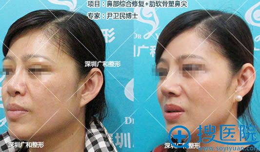 <!--<i data=20240710 data-id=12610></i>-->鼻综合修复+肋软骨垫鼻尖案例 <!--<i data=20240710 data-id=12610></i>-->鼻综合修复+肋软骨垫鼻尖案例