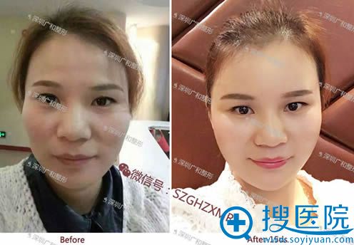 <!--<i data=20240710 data-id=12610></i>-->自体脂肪面部填充案例图 <!--<i data=20240710 data-id=12610></i>-->自体脂肪面部填充案例图