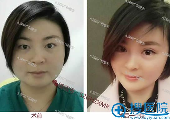 <!--<i data=20240710 data-id=12610></i>-->医院光雕瘦脸前后对比效果图 <!--<i data=20240710 data-id=12610></i>-->医院光雕瘦脸前后对比效果图