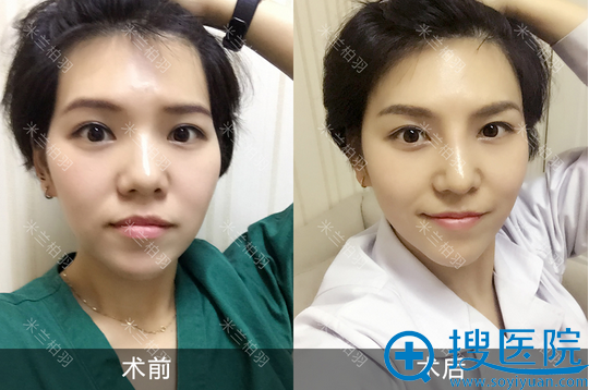 刘俊晶钻综合隆鼻手术前后效果对比 刘俊晶钻综合隆鼻手术前后效果对比