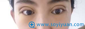 术后第九天,眼睛还没消肿,看起来比较宽 术后第九天,眼睛还没消肿,看起来比较宽