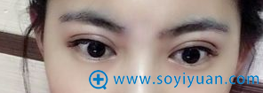 术后2个月,恢复的特别好,特别自然 术后2个月,恢复的特别好,特别自然