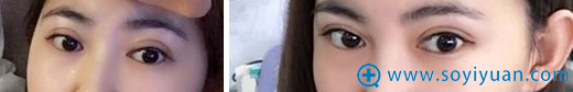 术后3个月了,越看越喜欢啊 术后3个月了,越看越喜欢啊