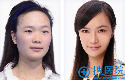 宁波美莱双眼皮+隆鼻对比案例 宁波美莱双眼皮+隆鼻对比案例