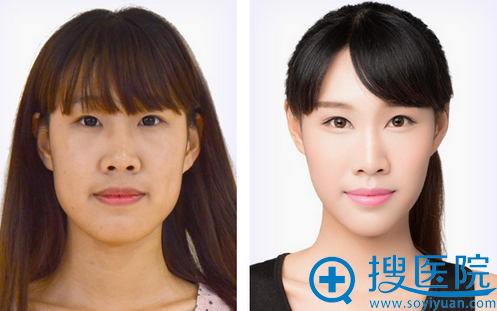 宁波美莱双眼皮+自体脂肪填充案例 宁波美莱双眼皮+自体脂肪填充案例