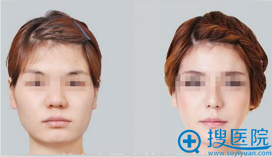 达拉斯综合美鼻案例图 达拉斯综合美鼻案例图